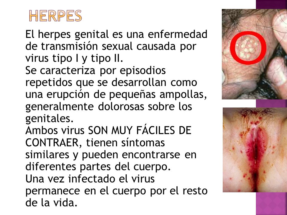 cuales son los tipos de infecciones de transmision sexualidad cuales son los tipos de infecciones de transmision sexualidad